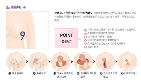 胸部太大怎么办?怎么缩小胸部?