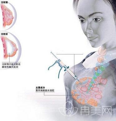 玻尿酸隆胸手术价钱贵吗?想知道区间是多少