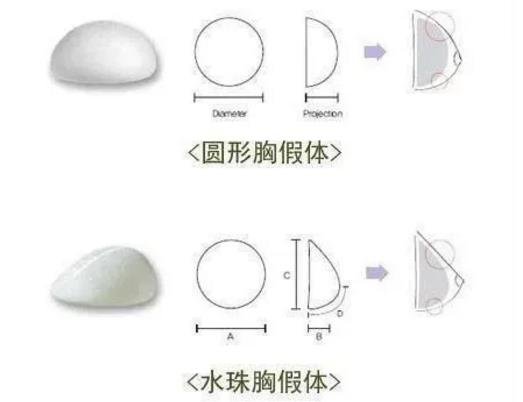 假体隆胸的*度高吗？隆胸假体应该怎么选？