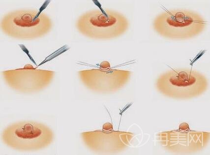 广州乳头缩小大概要多少钱？会影响哺乳和敏感度吗？