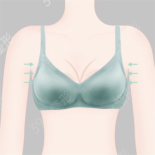 女士做副乳切除有禁忌吗?