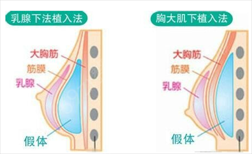 隆胸好的医院有哪些?