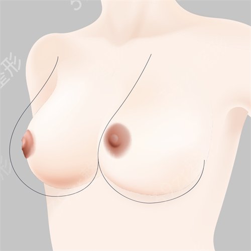 巨乳缩小需要多少钱?胸大困扰的看过来