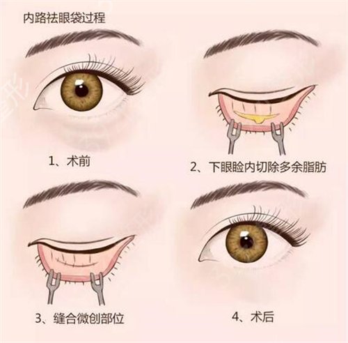 黑眼袋怎么去除？小窍门有哪些？