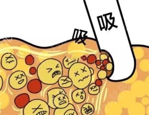 等离子溶脂减肥价格多少钱？