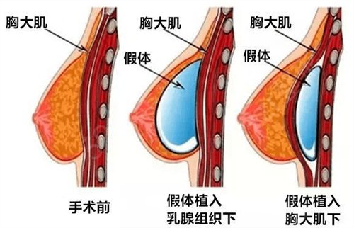 娜绮丽假体隆胸的*果怎么样?