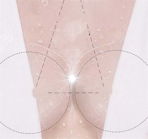 乳房再造手术费用要多少钱?保持时间及副作用普及