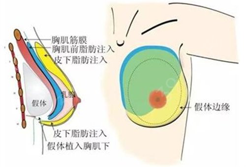 自体脂肪丰胸