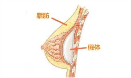 为什么你做假体隆胸会出现失败？当失败了我们怎么办?