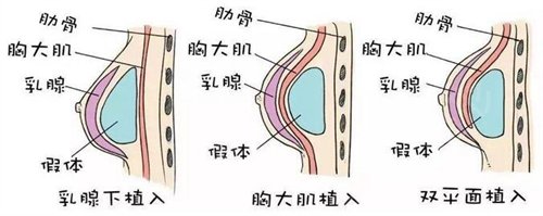为什么你做假体隆胸会出现失败？当失败了我们怎么办?