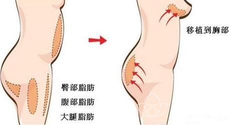 自体脂肪丰胸二次填充比*次成活率高吗?