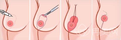 乳房下垂矫正