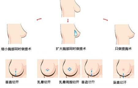 乳房下垂矫正