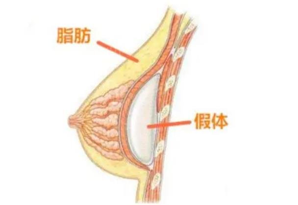 脂肪填充胸部多久恢复自然？脂肪填充胸部手术后的恢复时间