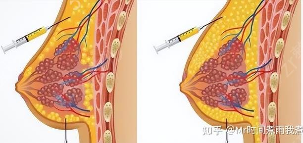 脂肪填充胸部成活率是多少？脂肪填充胸部的成活率