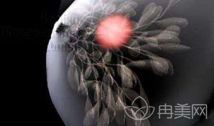 为什么你做假体隆胸会出现失败？当失败了我们怎么办?