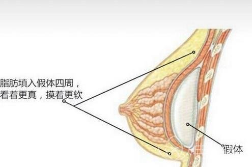 什么是复合式隆胸？它的利弊是什么